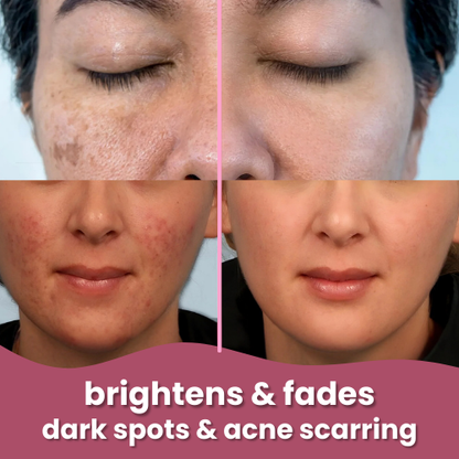 Dark Spot Corrector Kit™